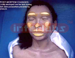 Postmortem lividity over the face with blanching at pressure points